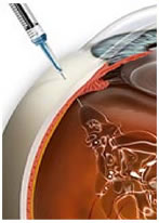 Intravitreal Enjeksiyon Serdar Ozler Goz Klinigi Doktoru Izmir